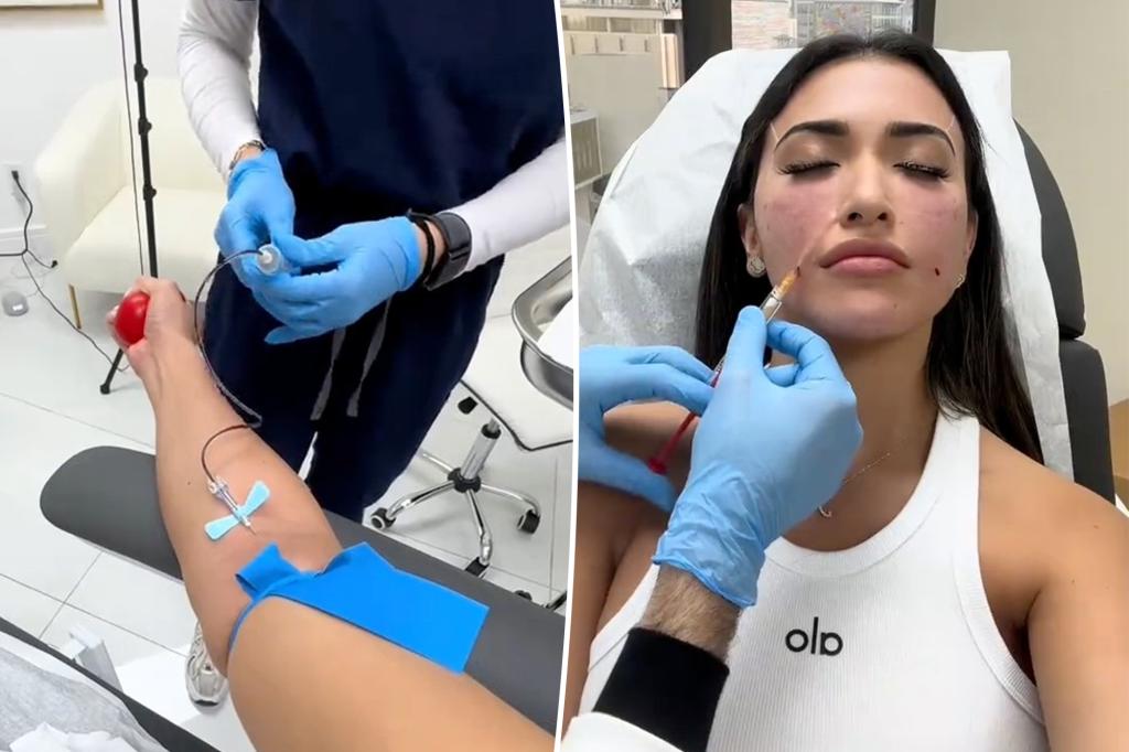 'Next-gen' filler craze uses your own blood - but docs warn it's 'unreliable'