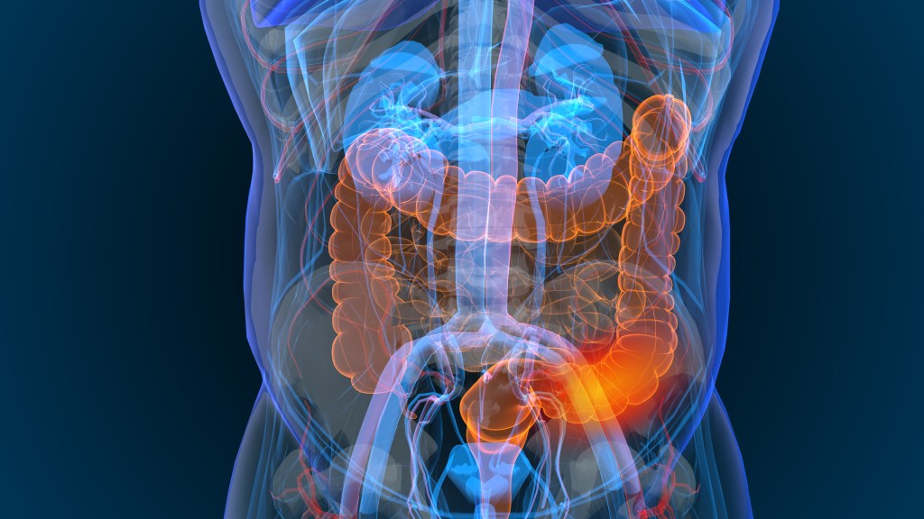 3D rendered illustration of bowel cancer displayed as an X-ray of a person's body